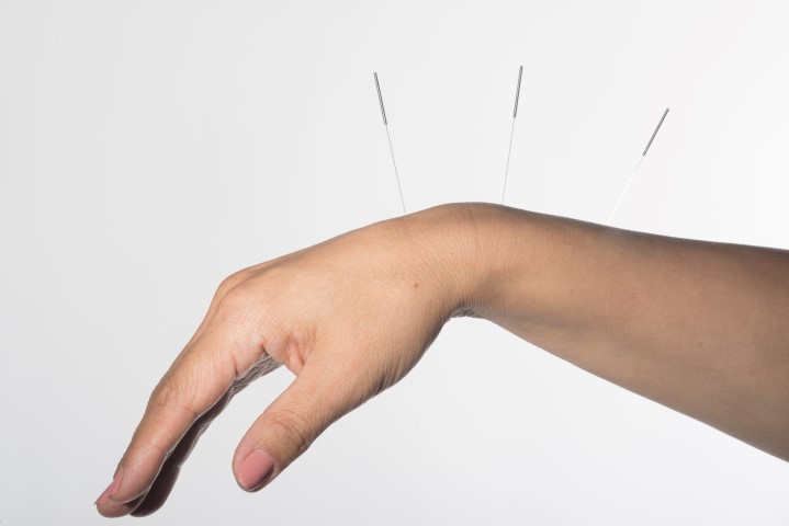 Drętwienie mrowienie rąk i nóg akupunktura medycyna wschodnia 