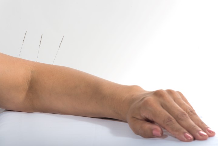 Niedowład kończyn akupunktura medycyna wschodnia 