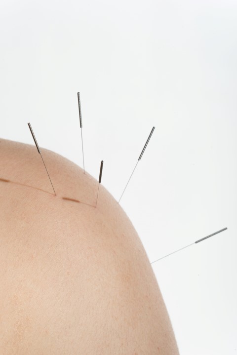 Rwa ramienna akupunktura 