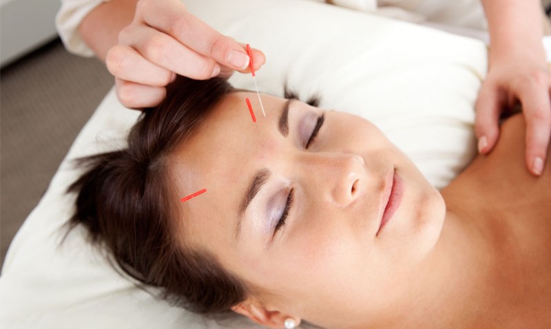 Bóle menstruacyjne medycyna wschodnia akupunktura 