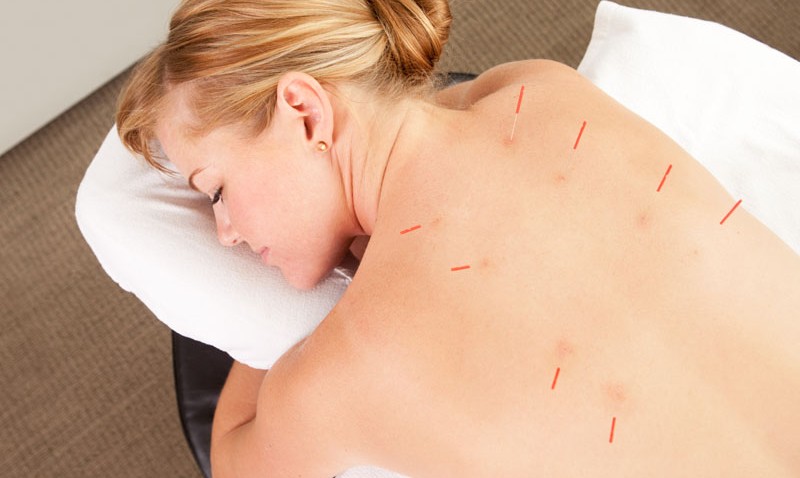 Bóle Kręgosłupa Leczenie Akupunktura Medycyna Wschodnia 
